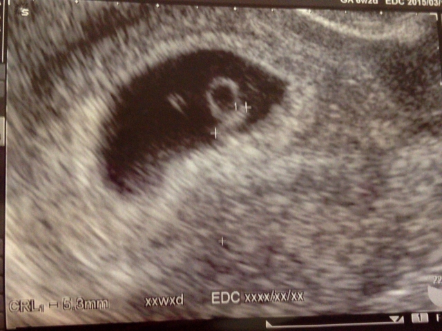 妊娠 初期 出血 茶色 6 週
